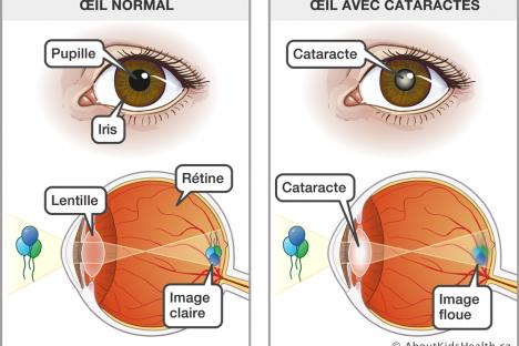 Chirurgie de la cataracte en Tunisie et en Turquie