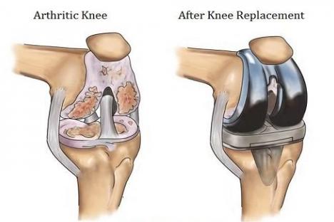 knee-replacement-1_627a915176803.jpg