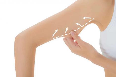 lifting-bras-1170x622_5f574c2ed8f39.jpg