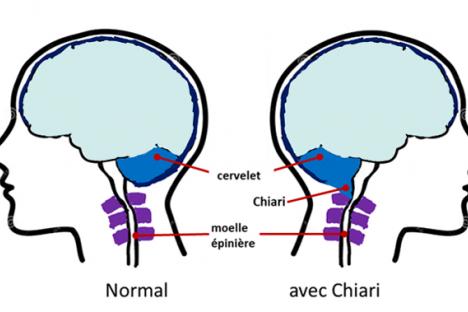 malformation-de-chiari-700x319_5f5b996c2d750.jpg