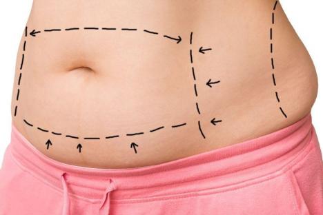 procedures-tummy-tuck-1160x560_5f574d7127b1d.jpg