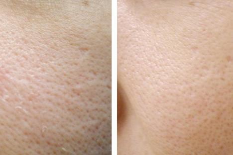 resultat-peeling-laser-carbone_5f5763db6fab3.jpg