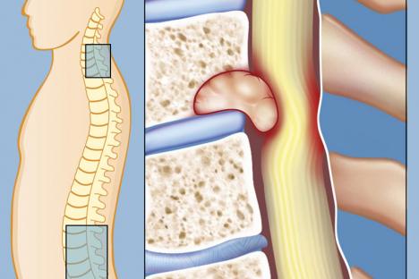 tumeurs-rachiennes-lg_5f574029944c6.jpg
